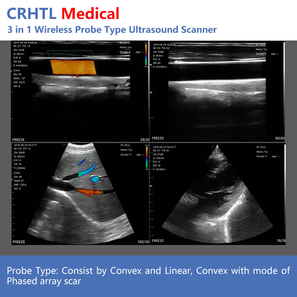 3 in 1 Wireless Probe Type Ultrasound Scanner Portable Machine Wifi Ultrasound Scanner Machine Support IOS Android Windows